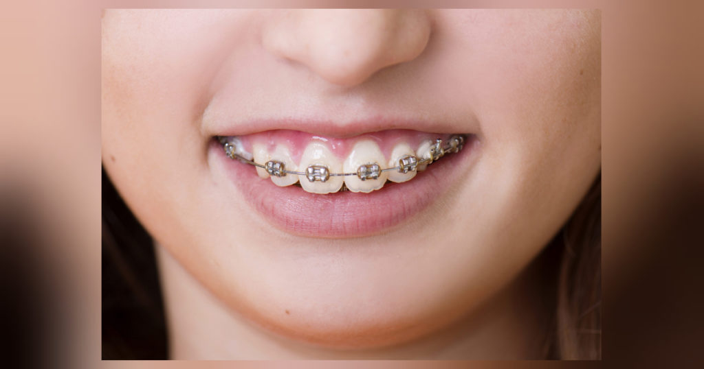 Die wichtige Zahnspange für unsere Zähne